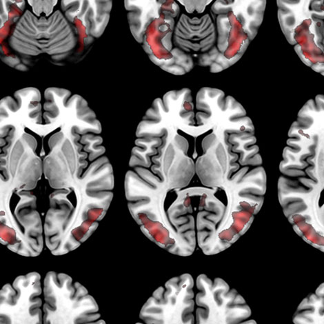 Multiple black and white  scans of a brain with red highlights.