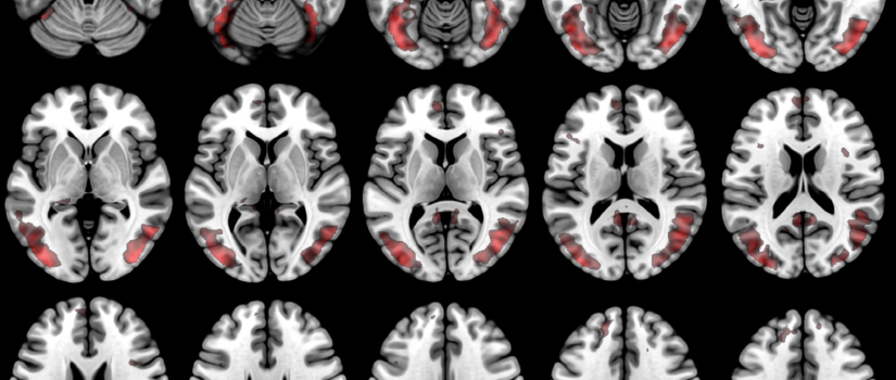 Black, white and red images of brain scans as rendered by the McCausland Center.