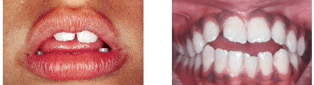 Myofunctional Disorder examples -- two sets of mouths showing mishapen teeth